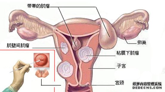 自我采集阴道拭子检测沙眼衣原体感染淋病和滴虫病