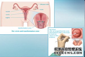 女性宫颈细胞收集